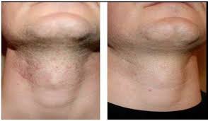 Preventing Ingrown Hairs With The No No Permanent Hair Removal System Hair Shedding Genius Shaving Bumps Razor Bumps Ingrown Hair Remedies
