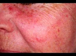 See full list on marieclaire.com Pin On Blood Vessels On Face