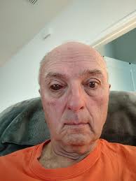 Had a small encounter with a hanging branch yesterday at Croom. A visit to  the ER yesterday, and then to my eye doc today