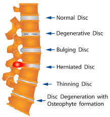 Spinal Stenosis Degenerative Disc Herniated Disc Bulging Disc