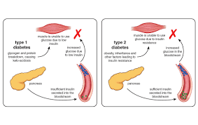 Metformin should also be avoided in people with liver disease, which can increase the risk to lactic acidosis. Metformin Out Of Backwaters And Into The Mainstream American Scientist