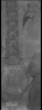 Harnleiterschienen Urologie Amriswil