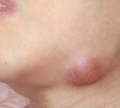 Image result for lump