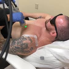 We use a clinically proven diode. Dalia Aziz Aesthetics Can Laser Hair Removal Be Done Over A Tattooed Area The Short Answer Is No It S Simply Not Safe To Get Laser Hair Removal Over A Tattoo If