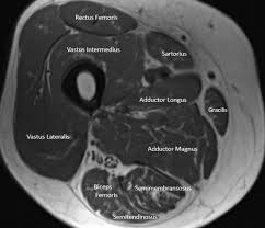 Department of anatomy and cell biology 1. Figure Cross Section Of The Thigh Contributed By Basem Attum Md Ms Statpearls Ncbi Bookshelf