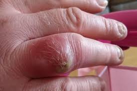 If someone bitten by a black widow spider experiences muscle cramps, emergency medical care may include blood pressure medication, muscle relaxants, and, in rare cases, antivenin. Dad Receives Emergency Operation For Horror Wound After Spider Bit Him While He Slept Liverpool Echo