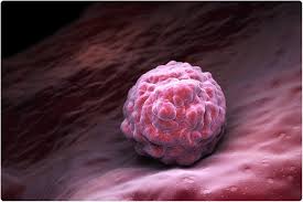 George iii, tarihçiler tarafından haksız yere kötü muamele gördü. Novel Biomarker Can Distinguish Malignant Lung Nodules