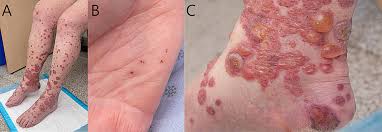 Image result for Vasculitis