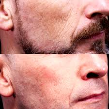 Dermaclinic in genk is een moderne dermatologische kliniek, gespecialiseerd in huidziekten, de nieuwste spatader behandelingen, cosmetische behandelingen en dermatochirurgie. Tixel