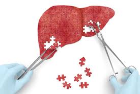 This rarely happens in people with early. What Happens In The 4 Stages Of Liver Disease Health The Jakarta Post
