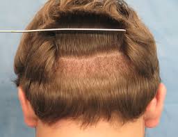 It is also at about eight months that the final hair growth pattern becomes apparent to the patient. History Of Hair Transplant Surgery Bernstein Medical