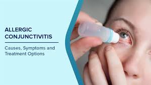 Image result for Allergic Conjunctivitis