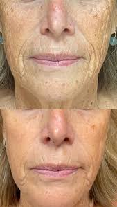 ✨🪄A little Friday inspo to change things up🪄✨ , ✨This deserving mom had a  huge improvement with texture and lines by having @lutronic_us Ultra laser  this was before and after 2 sessions. , ✨We love ...