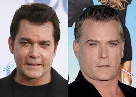 Many actresses and actors go under the surgeon's knife to maintain their youthful looks. Ray Liotta Plastic Surgery Facelift Botox Hair Transplant
