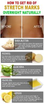 The Best Way To Remove And Get Rid Of Stretch Marks Naturally On Arms Thighs And Stomach Is To Moistu Stretch Marks Reduce Stretch Marks Stretch Mark Remedies