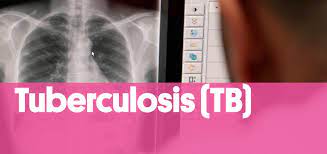 Лучшие жесткие диски для ноутбуков 2021. Tuberculosis Tb E Infecciones Por Micobacterias Tuberculosis Tb And Mycobacterial Infections Programa Isglobal