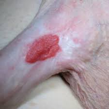 Pdf Extramammary Paget S Disease Of The Penis A Case Report And Review Of The Literature