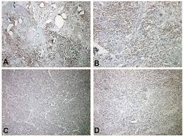 Merkel cell carcinoma is a rare type of skin cancer that tends to develop in older adults and in areas exposed to sunlight. Phospho Stat5b Expression Is A Prognostic Marker For Merkel Cell Carcinoma Anticancer Research