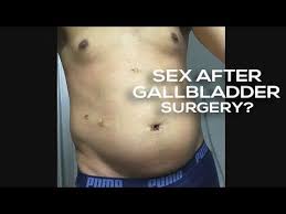 Seen in those with sickle cell disease). Gallbladder Removal Laparoscopic Cholecystectomy Nebraska Patient Education Youtube