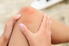 Prva na listi stvari kada postavite pitanje šta je dobro za otok jesu hladne obloge. 8 Razloga Zasto Imate Modrice Po Tijelu A Nije Zbog Udaraca 24sata