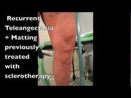 Image result for Perthes Test