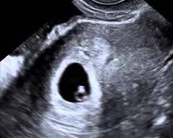 3 Semanas De Gravidez