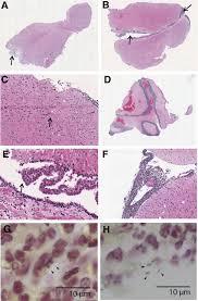 However, with older cultures the gram stain reaction can be variable and also cells may appear spheroidal. Characterization Of A Listeria Monocytogenes Meningitis Mouse Model Journal Of Neuroinflammation Full Text