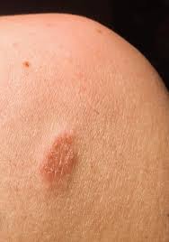 Image result for Eczema nummulare