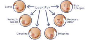 This happens when the fatty tissue in the breast become damaged and dies, causing a lump to form. Breast Cancer Develops From Breast Tissue And Cause A Lump In The Breast A Change In Breast Shape Dimpling Of The Skin