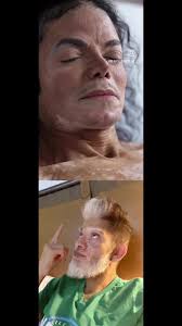 Michael Jackson Vitiligo Pictures