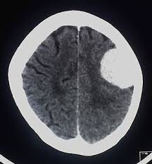 A scan of the head can provide important information about the brain, for instance, if there is any bleeding, swelling of the arteries, or a tumor. Meningioma Wikipedia