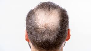 L'alopécie androgénétique est la forme la plus répandue de perte de cheveux chez les femmes. Alopecie Calvitie Pelade 10 Mythes Et Realites Sur La Perte De Cheveux Huffpost Quebec Vivre