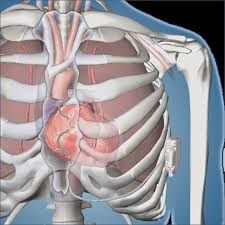 By defects in guidant pacemakers, guidant icds, medtronic pacemakers, medtronic icds and sprint. Defibrillators Of Medtronic