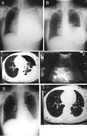 Treatment may fail if the catheter is not placed optimally within the loculation or if the fluid is hemorrhagic or fibrinous. Intrapleural Urokinase For The Treatment Of Loculated Malignant Pleural Effusions And Trapped Lungs In Medically Inoperable Cancer Patients Journal Of Thoracic Oncology