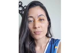 Con una lesión severa en el ojo izquierdo terminó la patinadora Shuyein  Sáenz después de que en una jornada de ejercicio que esperaba tranquila,  terminara arrollada por un scooter eléctrico en la