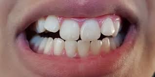 Case Study Biominf Fixes White Spots White Marks White Lesions On Teeth