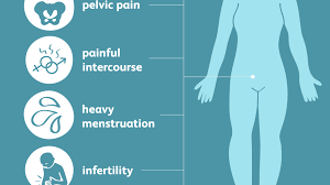 Some women with endometriosis have no symptoms, but those that do may have pelvic pain and pain intercourse, cramping during sex, bowel movements, or while urinating, and infertility. Symptoms Of Endometriosis