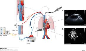 Bicaval Dual Lumen Cannula For Venovenous Extracorporeal