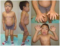 Diagnostic And Treatment Strategies In Mucopolysaccharidosis Vi Tacg