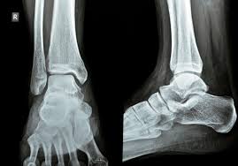 Image result for Ankle XRay