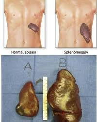 Image result for Splenomegaly
