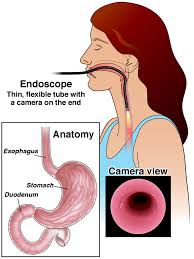 Upper GI endoscopy