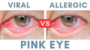 Image result for Allergic Conjunctivitis