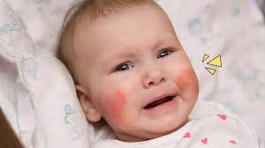 8 Penyakit Kulit pada Bayi dan Cara Tepat untuk Mengatasinya