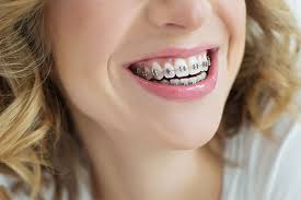 How to whiten teeth with braces? How To Whiten Teeth With Braces Clear Braces Staining Yellow