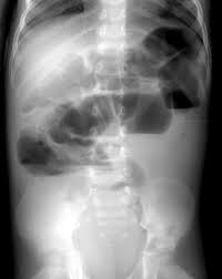 Image result for Adynamic Ileus