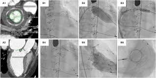 Transcatheter Aortic And Mitral Valve In Valve Implantation
