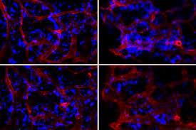 Sometimes secondary breast cancer can affect the bone marrow. Nanoparticles Can Turn Off Genes In Bone Marrow Cells Mit News Massachusetts Institute Of Technology