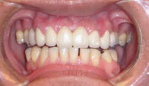 Dental Bridge Case Photo Mentor Oh Upper Front Teeth Replaced