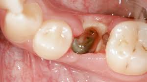 Image result for Alveolitis sicca)